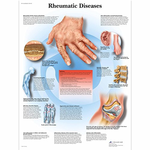 Image of 3B Scientific VR1124L Glossy Laminated Paper Rheumatic Diseases Anatomical Chart, Poster Size 20 inch Width x 26 inch Height