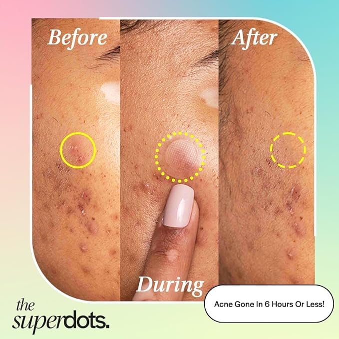 The Superdots Clarifying Pimple Patches, Translucent - Image 2