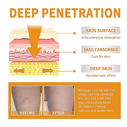 Facecoi VARICOSE VEINS MIRACLE CREAM Spider Varicose Veins Miracle Cream, Remove Varicose Veins For Legs thumb #2