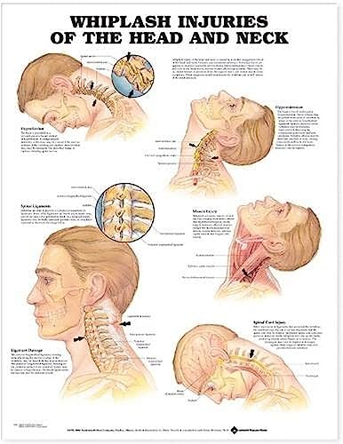 Image of Whiplash Injuries of the Head and Neck Anatomical Chart