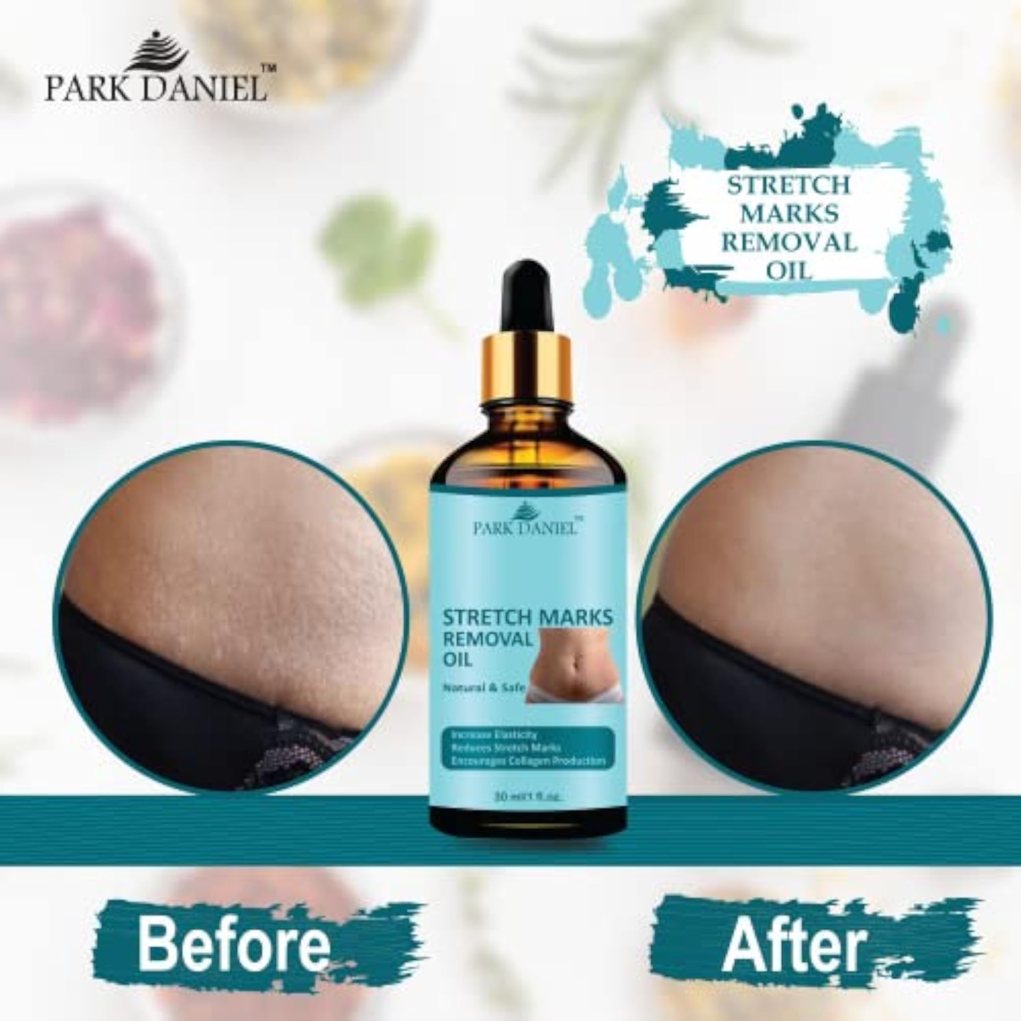 Premium Stretch Marks Removal Oil Combo Pack of 3