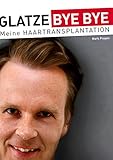 GLATZE BYE BYE-Meine Haartransplantation: Ein Erfahrungsbericht mit vielen Fotos
