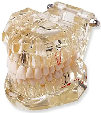 Myaskro Transparent Dental Model To Demonstrate Dental Implant Dental Diseases Cavities And Other Dental structures and processes Premium Quality