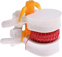 Vista 3 de Modelo de columna vertebral de hernia de disco lumbar, aumento 1.5X anatómica hernia lumbar humana disco intervertebral para enseñanza escolar