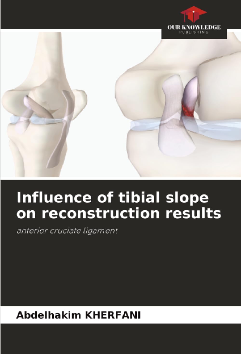 Influence of tibial slope on reconstruction results: anterior cruciate ligament