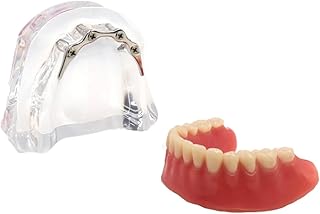 RUCYAI Dental 4 Implant Overdenture Restoration Lower Teeth Model Typodont 6008 6009 Gold (6008)