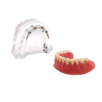 Dental 4 Implant Overdenture Restoration Lower Teeth Model Typodont 6008 6009 Gold 6008