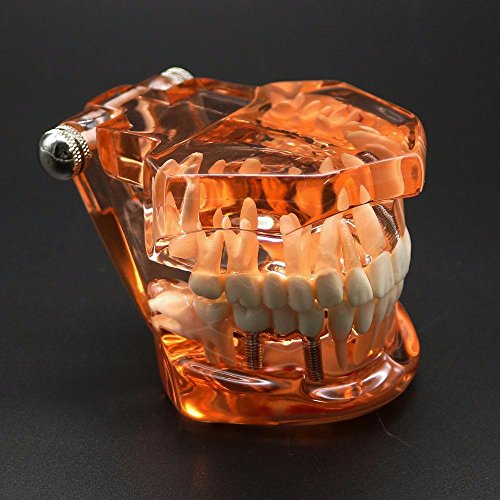 Dental Implant Disease Pathologies Study Teachin Demonstration Dentist Teeth Care Typodont Model With Restoration & Bridge Tooth #TOP1