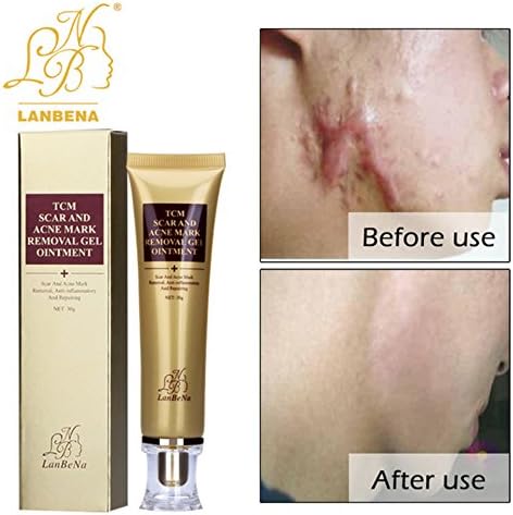 2pcs/Lot CEZUBEM Acne Scar Removal Cream Skin Repair Face Cream For Burns Cuts Operation Stretch Mark Remover Acne Scar Treatment. LANBENA Whitening cream