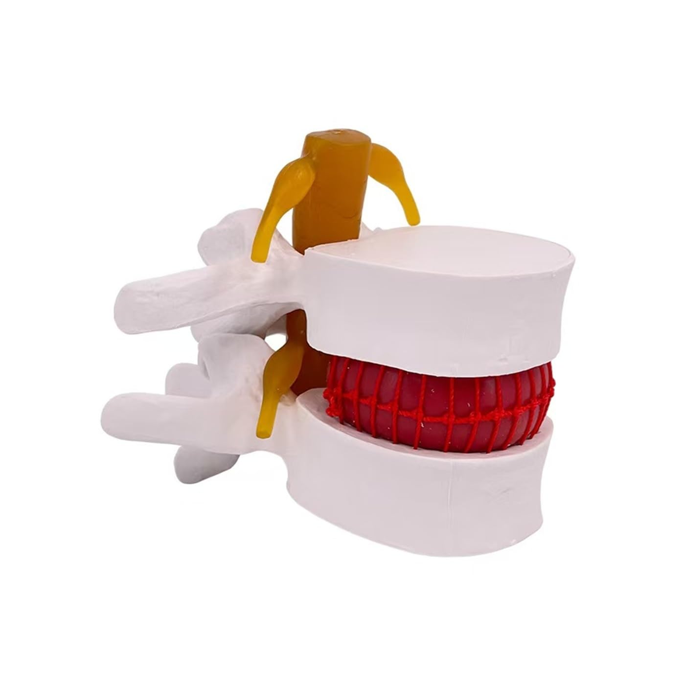 YNIYUJKL Anatomical Lumbar Disc Herniation Model, 1.5X Life Size Human Lumbar Vertebrae Herniated Disc Model, Doctor Verified Lumbar Spine Demonstration Tool, For Medical Teaching & Le