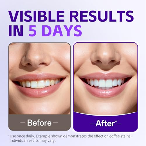 Image of PERSMAX Purple Teeth Whitening Strips, 14 Treatment, 28 Non-Slip Strips Kit | Professional Gum-Safe Formula, Pain-Free Express White in 30 Min for Sensitive Teeth, Easy to Use for Bright White Smile