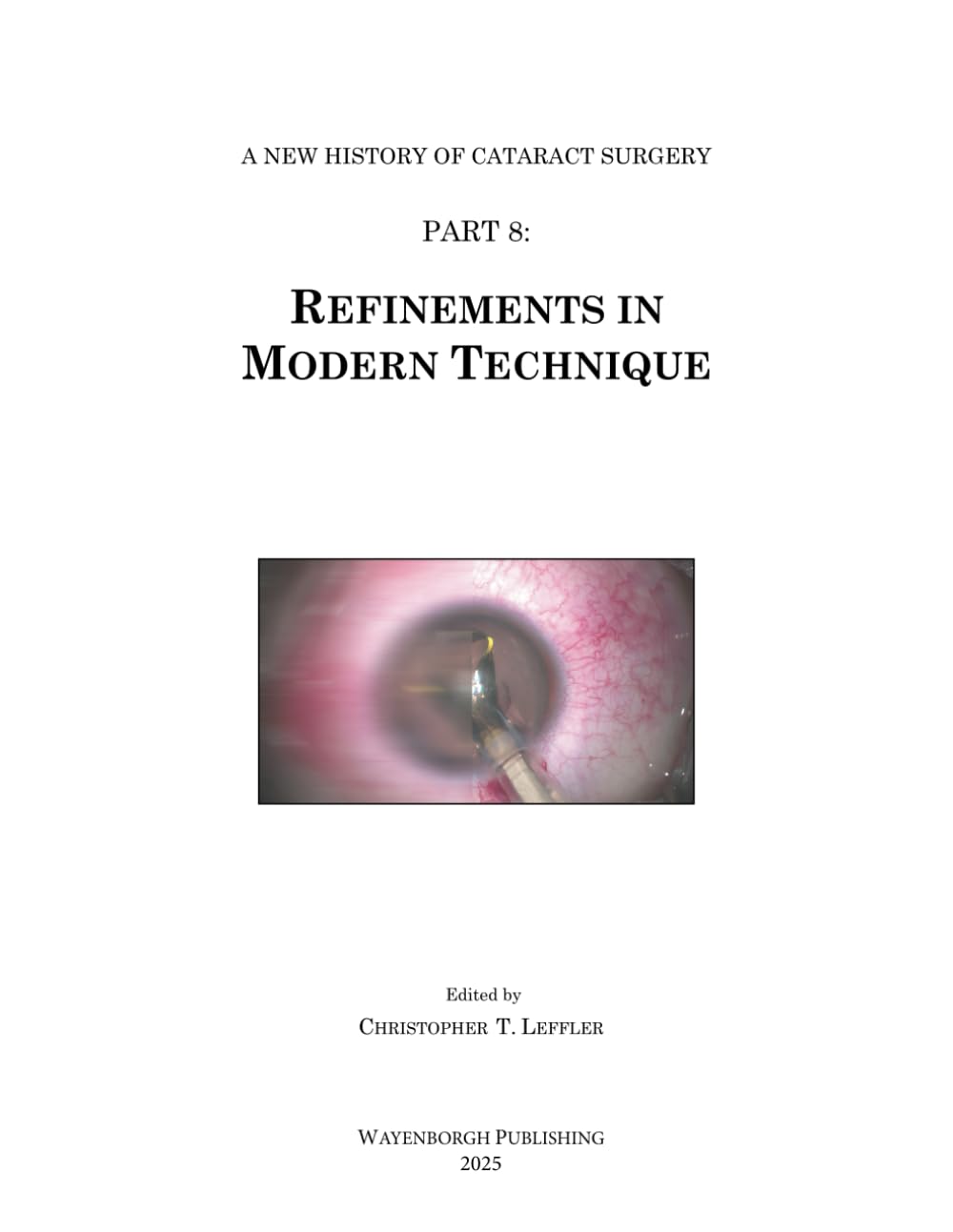 History of Cataract Surgery: Refinements in Modern Technique (A New History of Cataract Surgery)