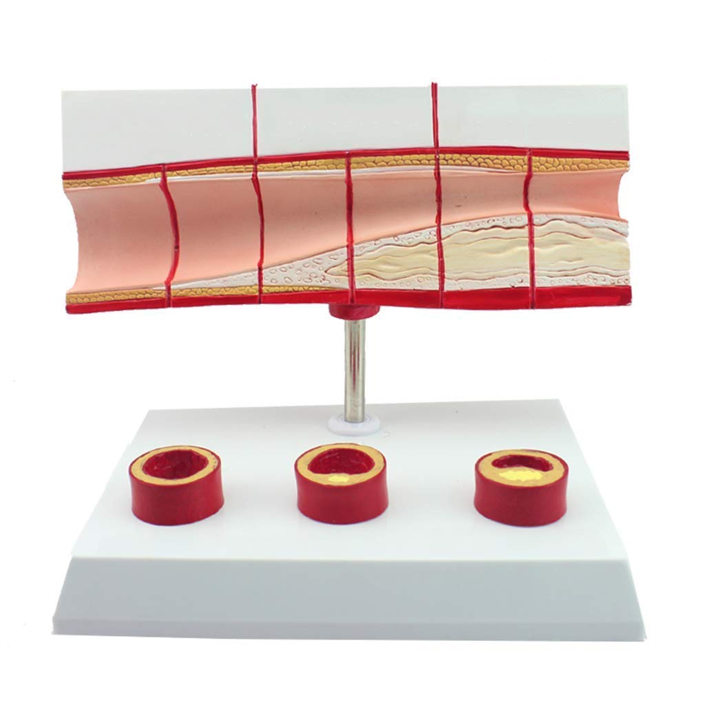 Model miażdżycy tętnic, model miażdżycy ludzkiej sercowo-naczyniowej, model anatomiczny, medyczny materiał edukacyjny, 10-krotny