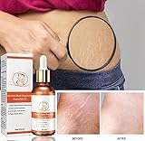Zoom IMG-2 skin stretch mark repair and Zoom IMG-2 skin stretch mark repair and