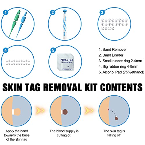 Foreverup Stielwarzen Entfernen Schnell Kit, Skin Tag Entferner, 2 In 1 Skin Tag Remover, Auto Skin Tag Remover Kit für… - Image 7