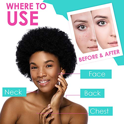 Bye Bye Blemish Acne Drying Lotion, Reduce Pimples Overnight 1Oz, 3-Pack #TOP4