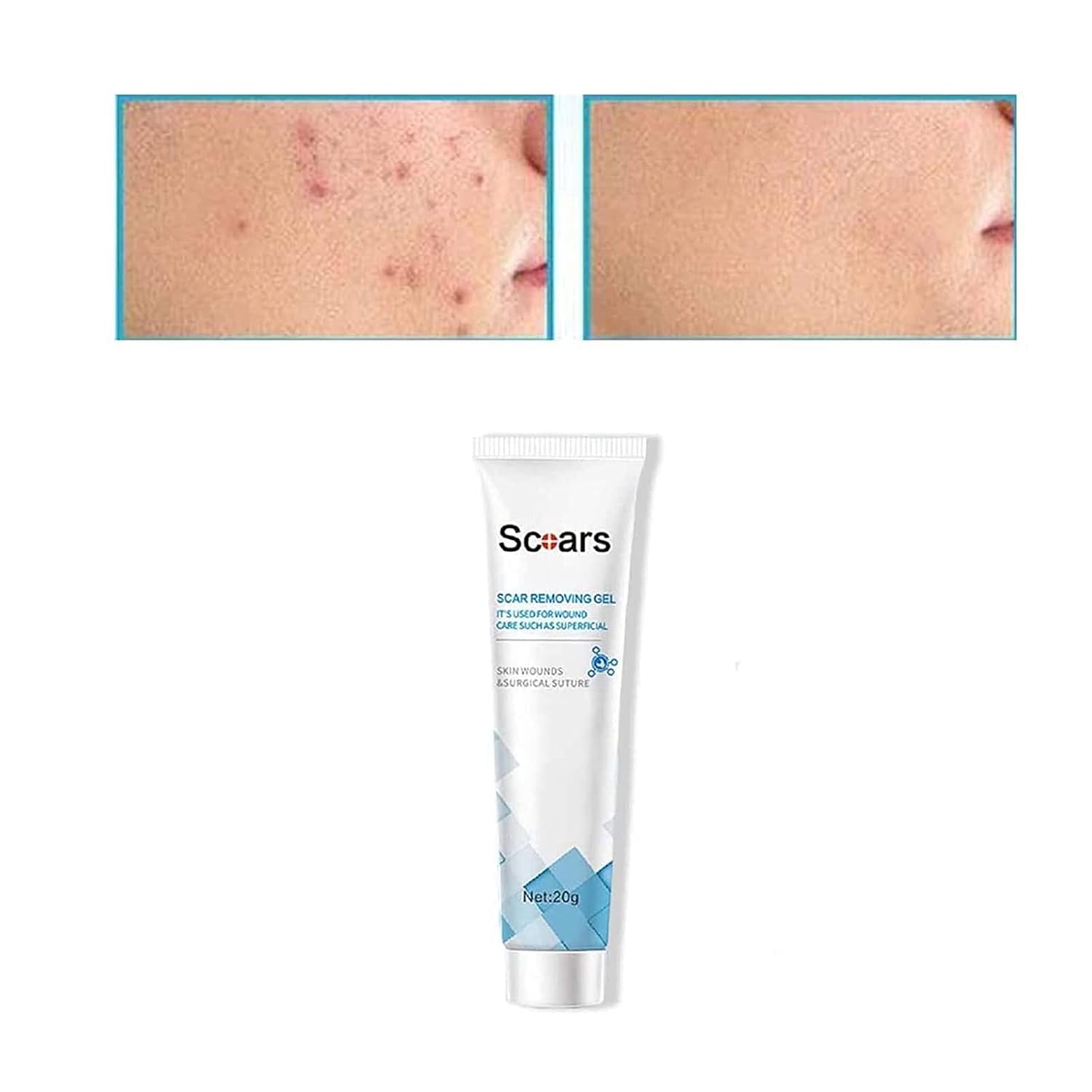 PICKX Organic Scar Removing Gel, Keloid Scar Removal Cream