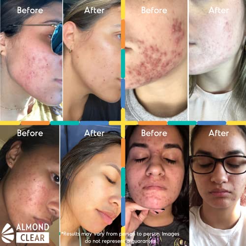 Face & Body Clearing Serum, Level 1-4 Fl Oz- For Acne, Folliculitis, Aging Skin, Ingrown Hairs, Dark Spots - Mandelic Acid #TOP2