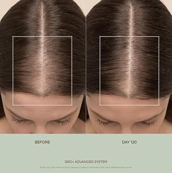 VEGAMOUR GRO+ Advanced Balancing Shampoo and Conditioner Kit | Removes Buildup, Hydrates the Scalp and Softens Strands | For Severe Signs of Thinning | Color Safe, Vegan, Cruelty-Free (8 Fl Oz each)