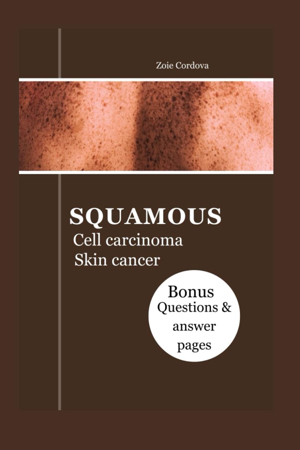 SQUAMOUS CELL CARCINOMA SKIN CANCER: The Illustrated Guide: Types, Diagnosis, Treatment, Prevention, Resources, Management And Question to ask your doctor
