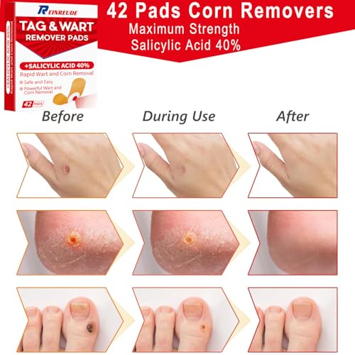Image of Plantar Wart Corn Remover Pads for Feet Toes: 42 Pack 40% Salicylic Acid Extra Strength Treatment - Fast Effective Medicated Bandages for Adults Seniors Teens Athletes Runners Hikers Workers Men Women