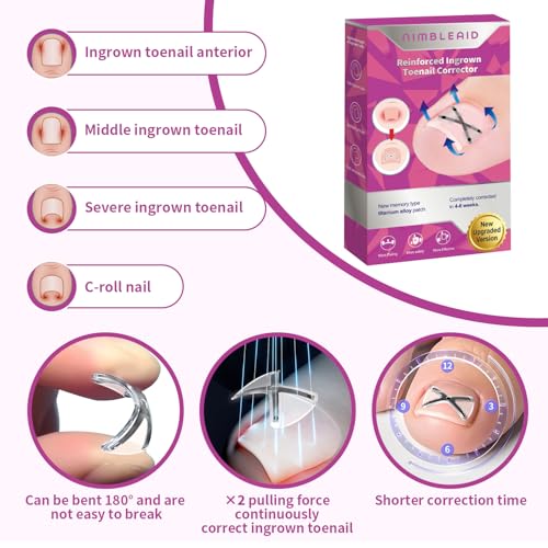 X-Shaped Titanium Alloy Toenail Corrector | Ingrown Relief