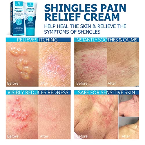 Roycederm Shingles Pain Relief Cream, Anti Itch Cream Extra Strength, Shingles Treatment, Shingles Itchy Relief Cream, for Eczema, Shingles, Nerve Pain, and Rashes.