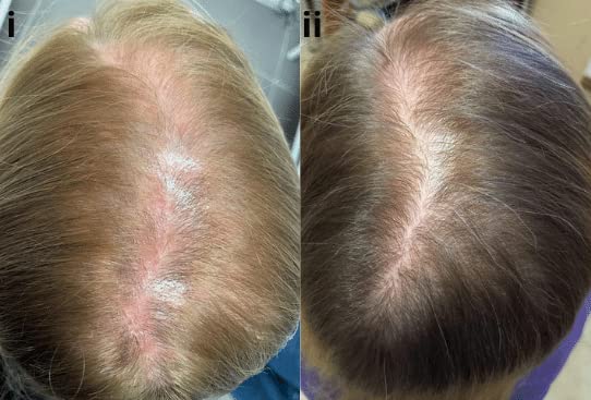 Miniatura 6 de Dr.UGro Gashee Suplemento para el crecimiento del cabello para hombres y mujeres vitaminas para el cabello más grueso y fuerte. Promueve el