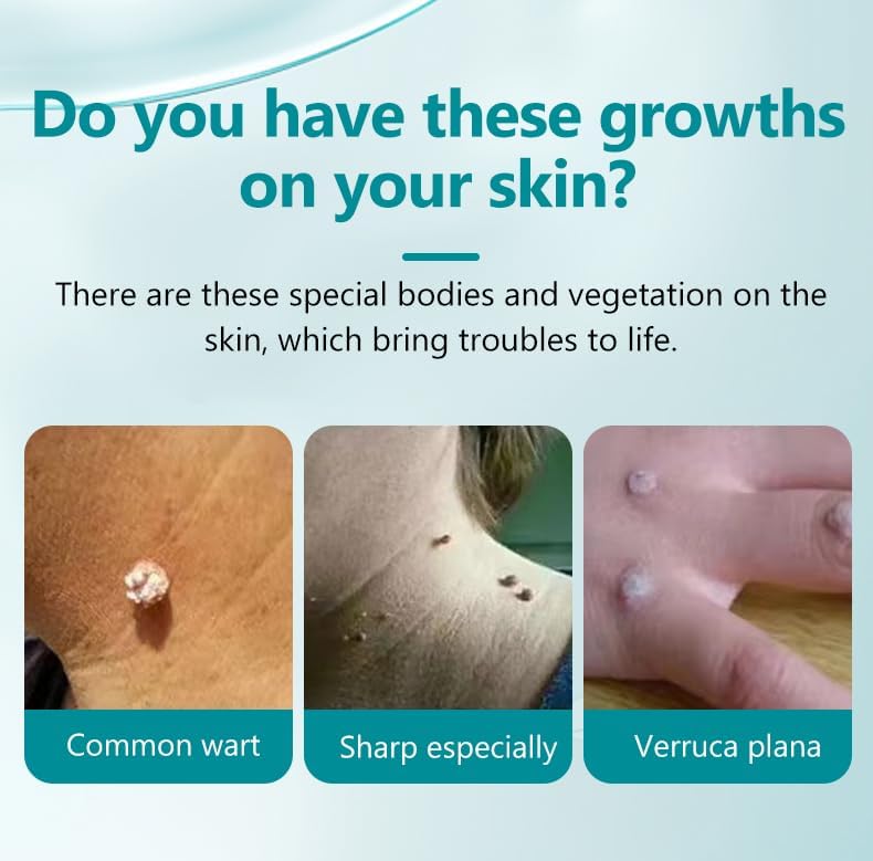 Wart Remover,Fast Acting Salicylic Acid Remover with 17%,Wart Remover Freeze Off Treatment for Plantar, Genital, Common Warts, Flat Warts(30ml) - Image 4