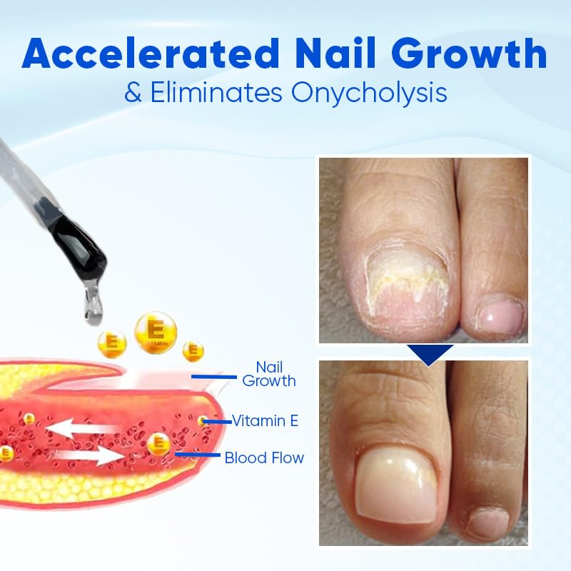 OnyxoGuard Nail Growth and Repair Serum, Advanced Nail Growth Serum, Nail Growth and Strengthener - Revitalize And Strengthen Your Nails 0.5 fl.oz (1 Bottle)