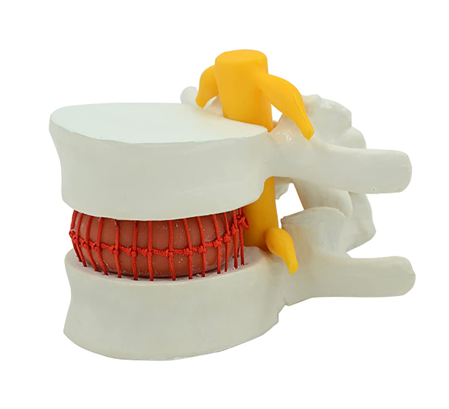 Buy Human Anatomical Lumbar Disc Herniation Model, Lumbar Spine Model
