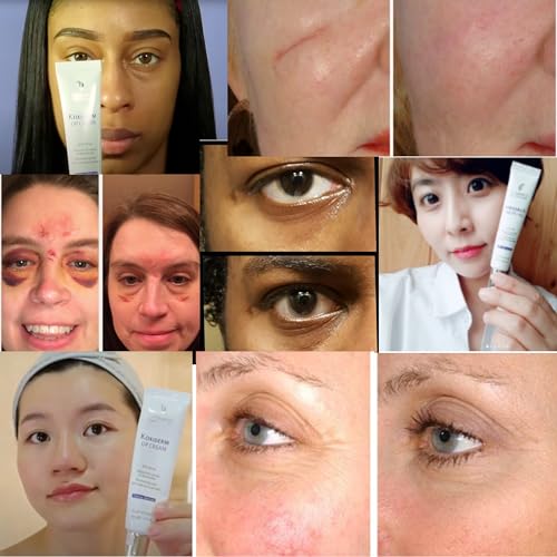 Anacis Vitamin K1 Oxiderm Cream Minimizing Appearance of Old and New Scars, Dark Eye Circles, Bruises, Varicose Veins, Purpura and Redness 1.01Oz - Thumbnail 4