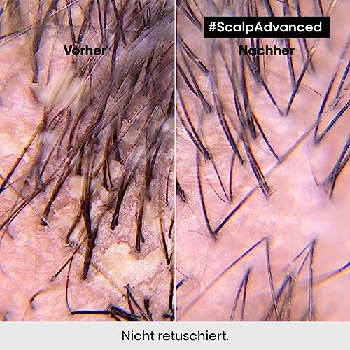 Foto von L'Oréal Professionnel Haarshampoo gegen Schuppen bei trockener & fettiger Kopfhaut, Scalp Advanced, Anti-Dandruff Dermo-Clarifier Shampoo, 300 ml