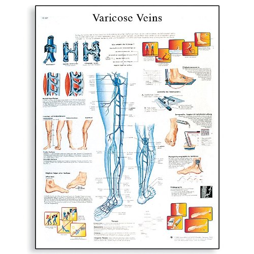 Image of 3B Scientific VR3367L Glossy UV Resistant Laminated Paper Afeccion Por Varices, Varicosidades Anatomical (Varicose Veins Anatomical Chart,Spanish), Poster Size 20 inch Width x 26 inch Height, Yellow