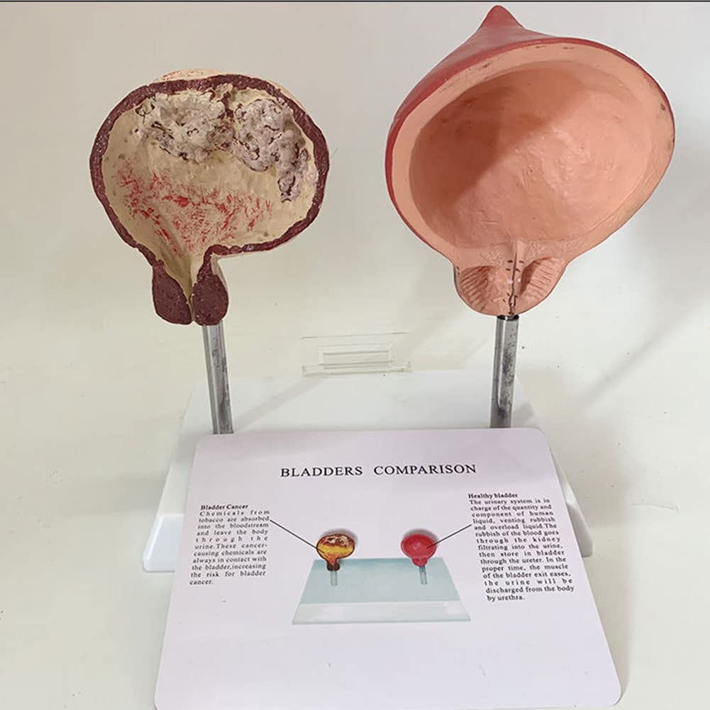 Buy YZDKJDZ Human Pathological Bladder Anatomy Model Comparison Smoking