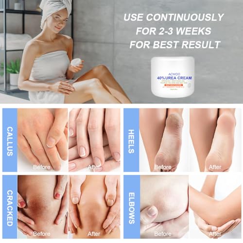 ACWOO Urea Cream 40%, Urea Foot Cream, 150g Urea Cream for Feet, Urea Foot & Hand Cream for Cracked Heels and Dry Skin, Foot Nourishing Frost for Callus Remover, 40% Urea Lotion for Feet - Image 4