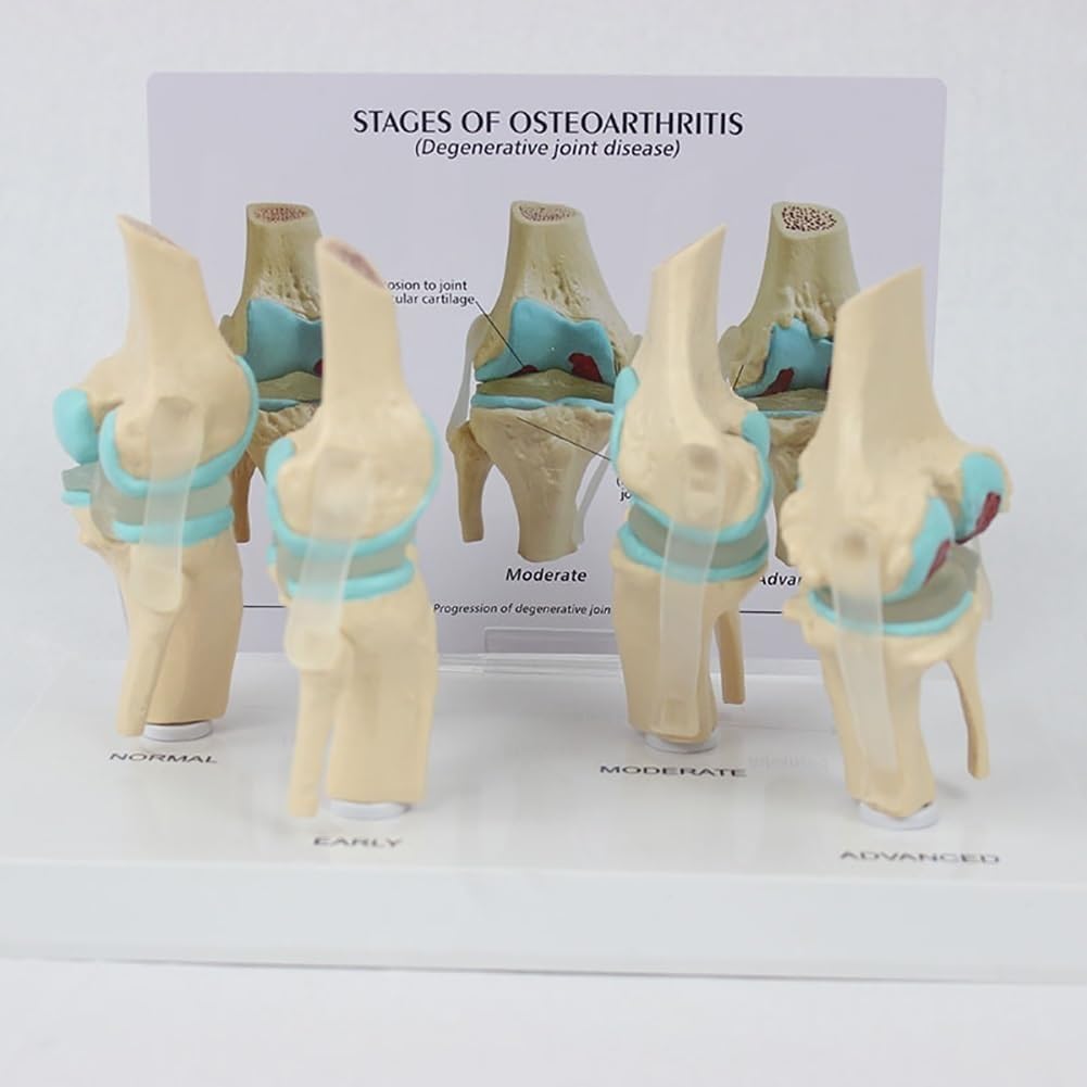 Model anatomiczny choroby zwyrodnieniowej stawów, ludzki 4 stopnie, materiał PCW z podstawą do ekspozycji edukacyjnej w klasach
