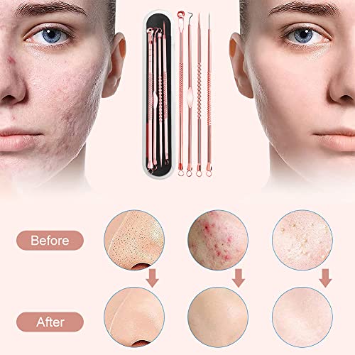 Pickel Ausdrücken Werkzeug,Pickelentferner,Mitesserentferner,Komedonenquetscher,Gesichtsreinigungs- und… - Image 8