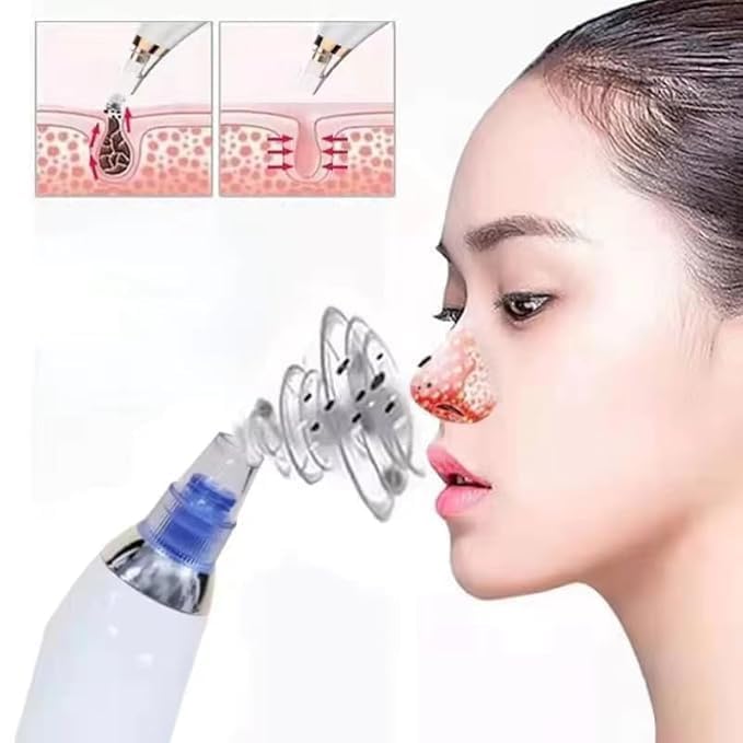 Image of 4 In 1 Multi-Function Blackhead Whitehead Extractor Remover Device Facial Cleansing Tool,Skin Cleaner,Pimple Removal Tool,Acne Pimple Pore Cleaner Vacuum Suction Tool For Men & Women