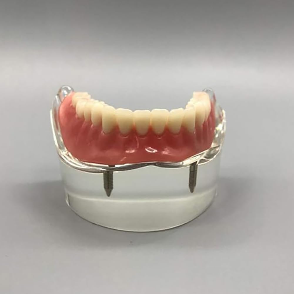 Modelo Dental - Modelo de Dientes de Implantes Dentales- Sobredentadura Dental Mandibular Inferior 2 Implantes Demo para Enseñar y Estudiar