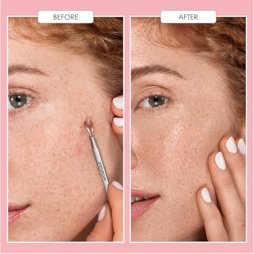 JAPONESQUE Pore-Fection Clear Skin Set, Blackhead Remover and Comedone Extractor Tools, Stainless Steel Pore Cleaning Kit, 2 Piece Acne Tool Set with Travel Case