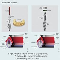 Vista 8 de O-Ring, Buna-n, Tool Kit with 3 Convenient Sizes, Replacement for Mini Dental Implants