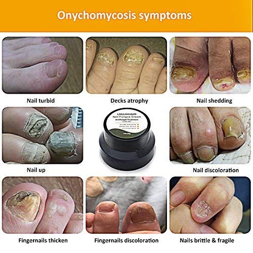 Nail Fungus Cream,Fungus Stop,Foot Fungus,Anti fungal Nail,Fungus Treatment Cream,Foot & Nail Fungus Treatment,Effective Against Nail Fungus,Repair and Protect Nails (20g) - Thumbnail 3