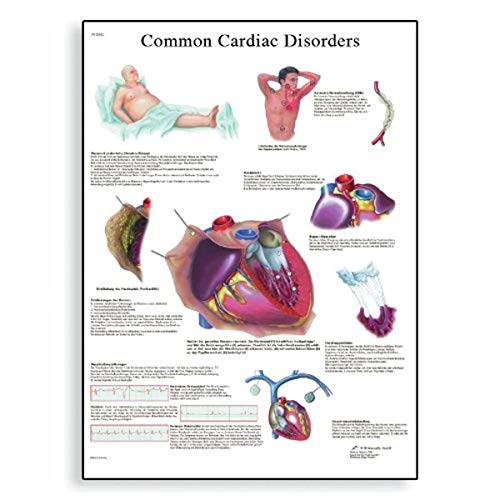 Image of 3B Scientific VR1343L Glossy Laminated Paper Common Cardiac Disorders Anatomical Chart, Poster Size 20 inch Width x 26 inch Height