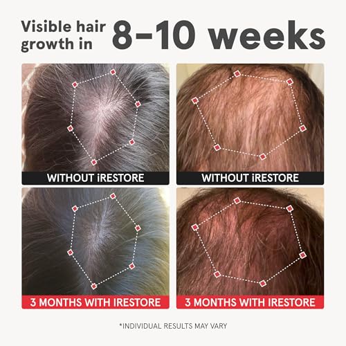 iRestore Advanced Hair Growth Supplement for Women