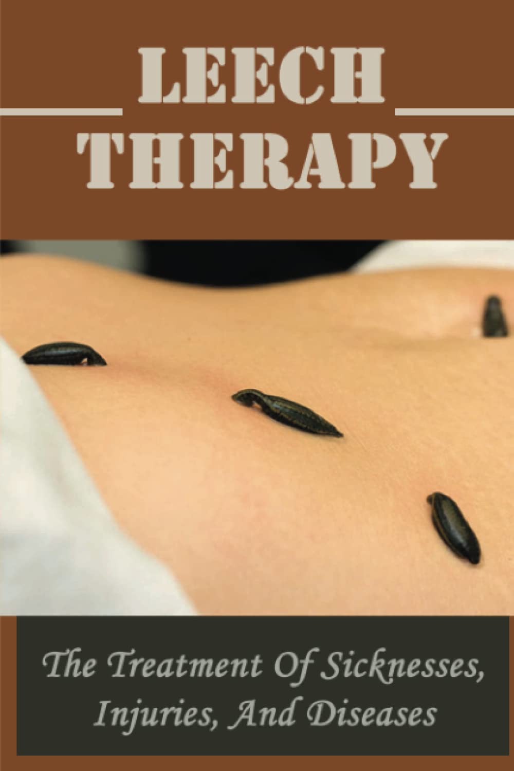 Leech Therapy: The Treatment Of Sicknesses, Injuries, And Diseases
