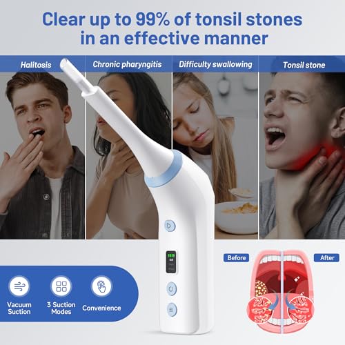 Image of Electronic Tonsil Stone Remover, Vacuum Tonsil Stone Removal Kit with LED Light, 3 Suction Modes, Tonsil Stone Cleaner Tool, Oral Care for Mouth Health, USB Rechargeable (White 2)
