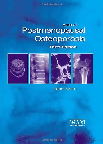 Atlas of Postmenopausal Osteoporosis: Third Edition