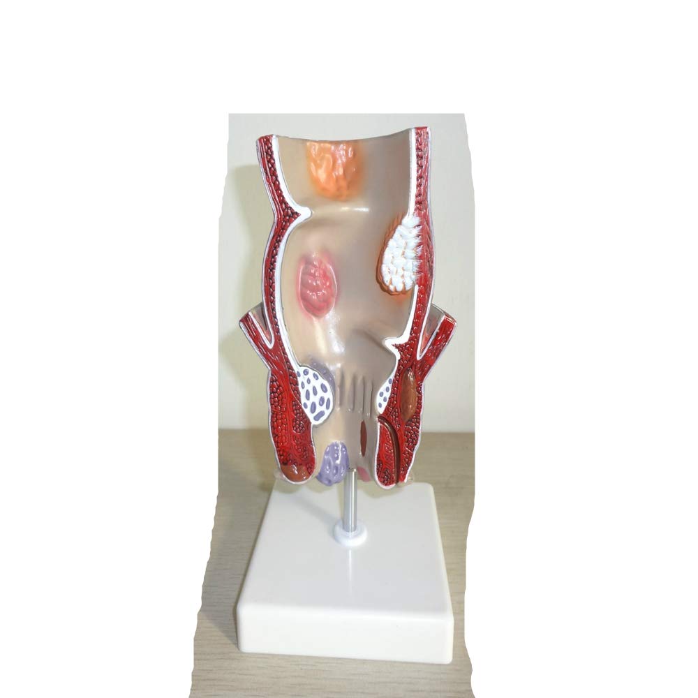 Human Anatomy Rectal Hemorrhoid Lesion Model, Anorectal Internal And External Hemorrhoid Model, Anal Fistula Fissure Model, Medical Hemorrhoid Model