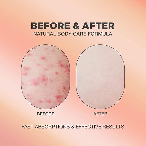 Miniatura 2 de Suero de tratamiento para el acné en los glúteos y el cabello encarnado | AHA y BHA Tratamiento para el acné de glúteos y cabello encarnado para